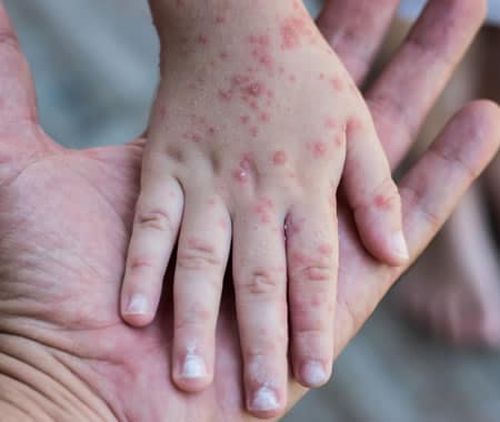 In Italia è stata eliminata la rosolia. Malattia infettiva pericolosa in gravidanza