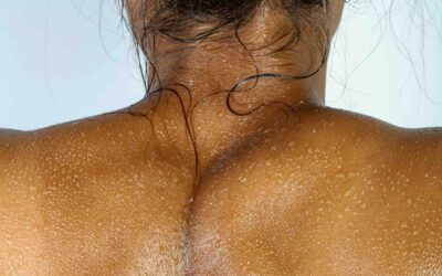 Estate, vacanze, sole ma attenzione al melanoma